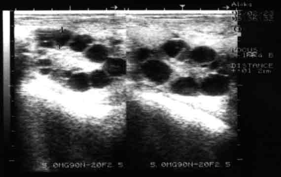 Ultrasonograph of a camel ovary 8 days after treatment with exogenous gonadotrophins to stimulate follicle development.