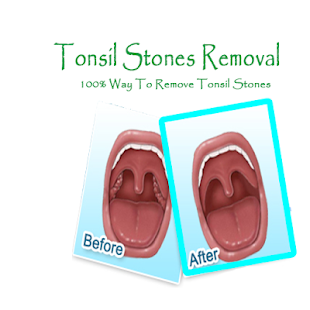 How to mod Natural Tonsil Stones Removal patch 1.1 apk for laptop