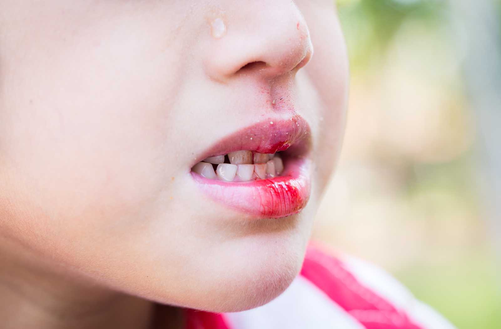 close up of child's mouth wth a tooth injury in need of emergency dental care.