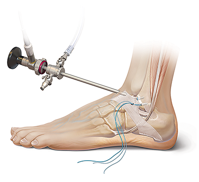 ankle ligament surgery