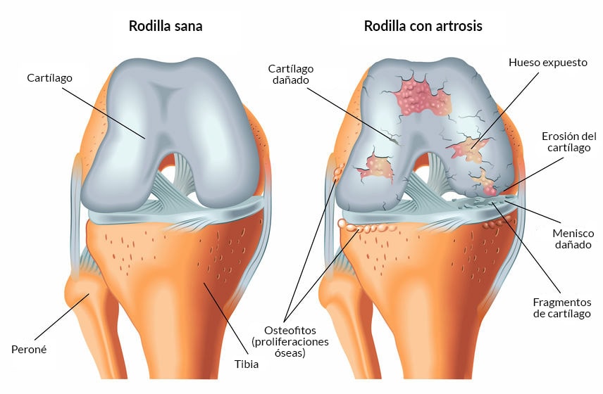 Artrosis de Rodilla