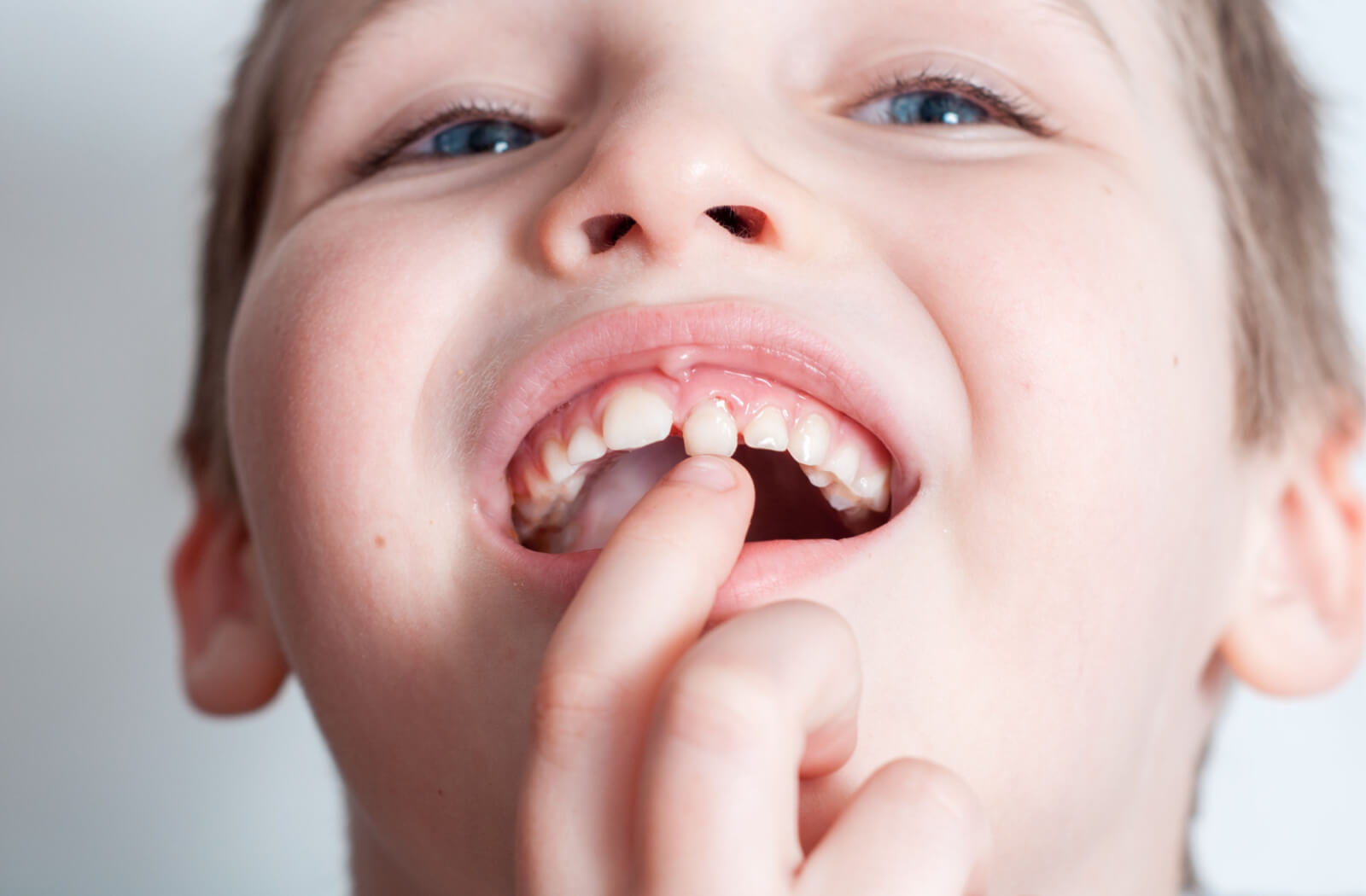 A male child is showing his loose tooth by touching it on his right index finger.