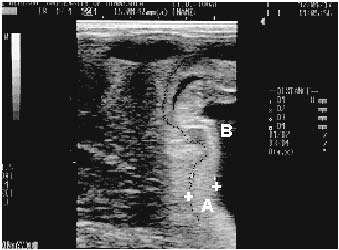 Ultrasonografía transabdominal y transrectal de la placenta de una yegua durante el noveno mes de gestación. El espesor conjunto útero-placentario (A) es anormal (11 mm) y la placenta se encuentra separada en la proximidad del cérvix. El borde externo del útero está delimitado por puntos negros y el líquido alantoideo (B), marca el borde interno de la placenta.