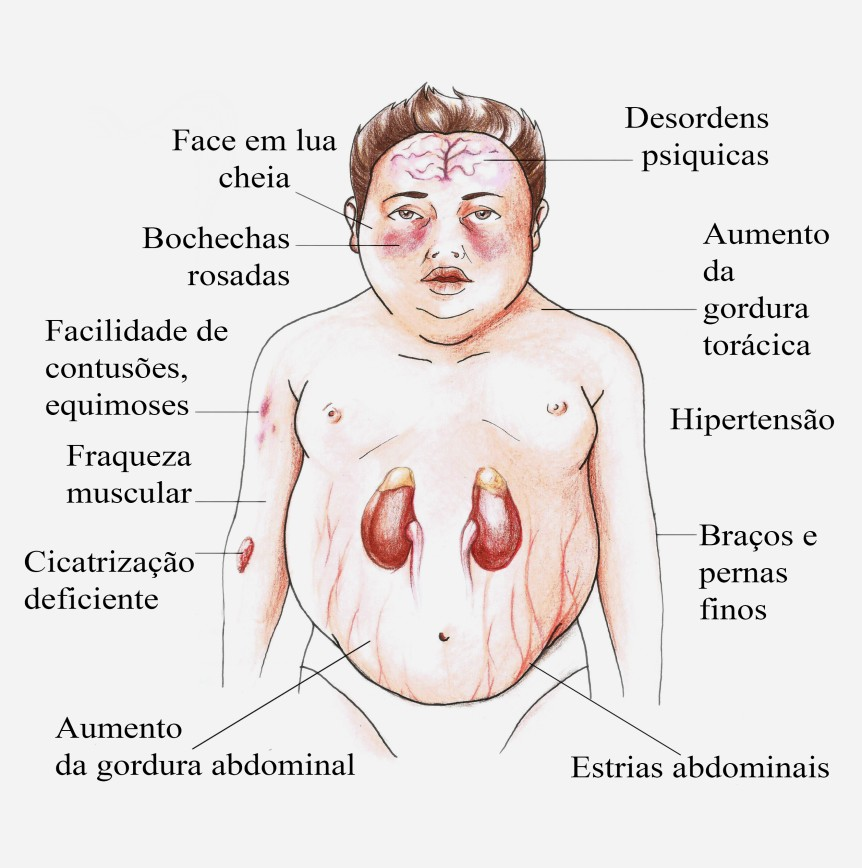 corticoide