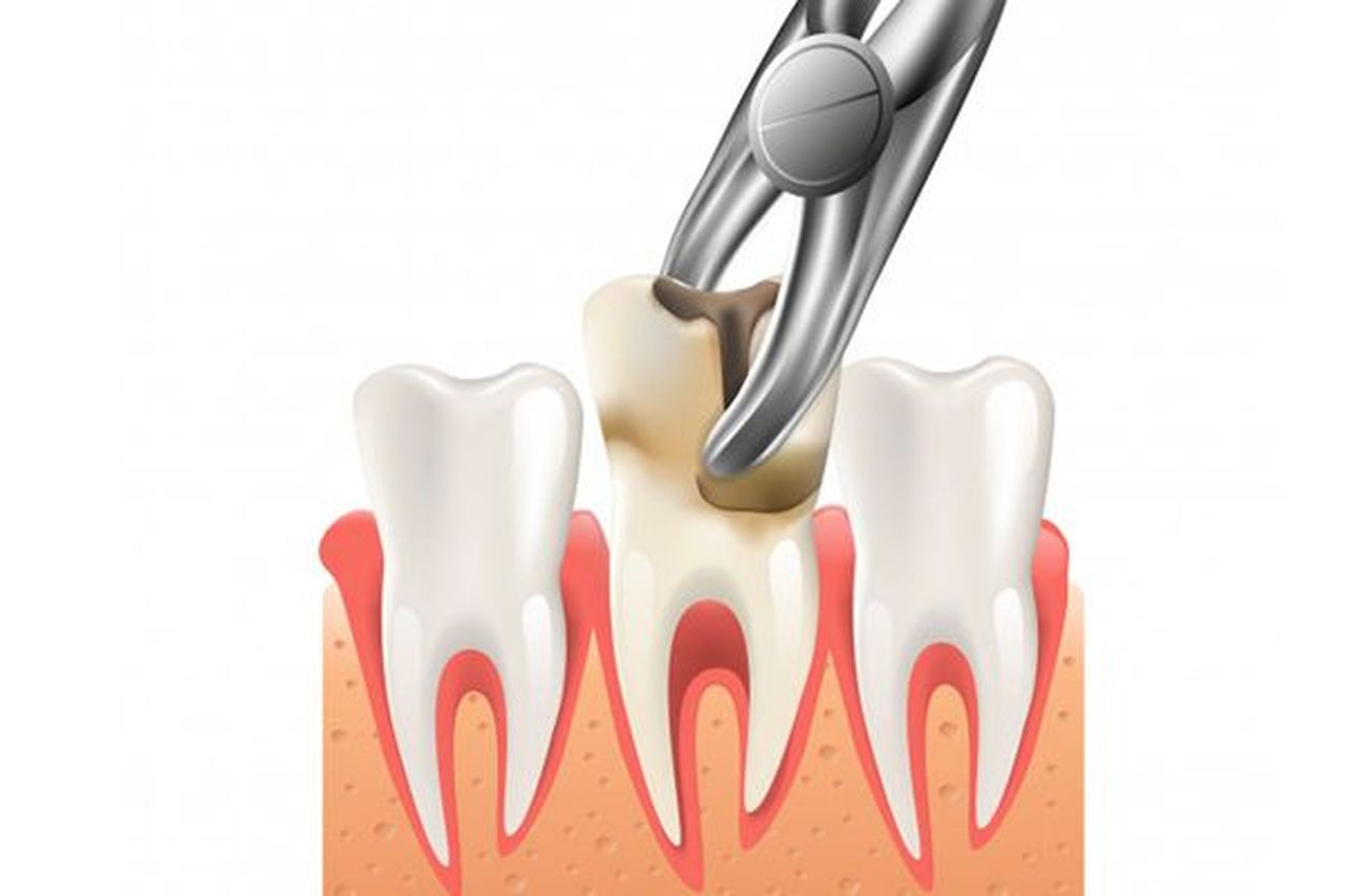 Removing tooth