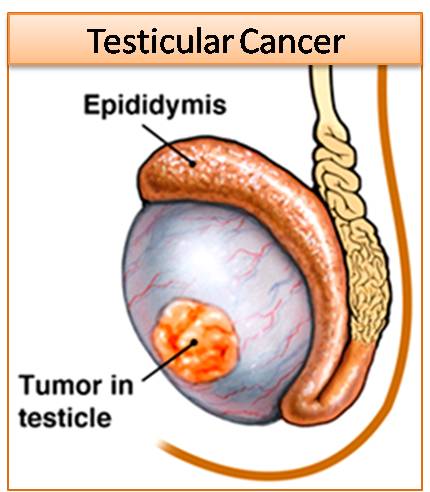 testicular-cancer.jpg