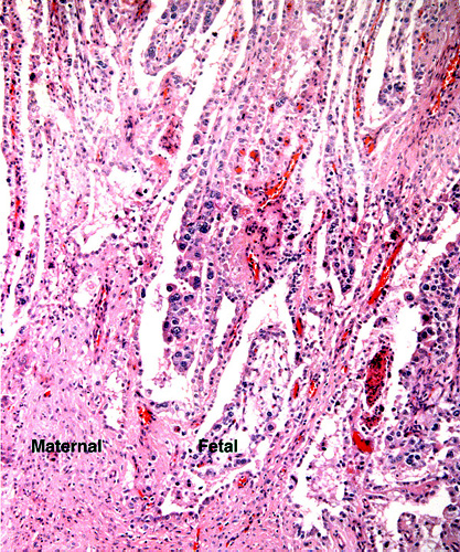 Enlargement of implantation site with interdigitation of maternal and villous tissues