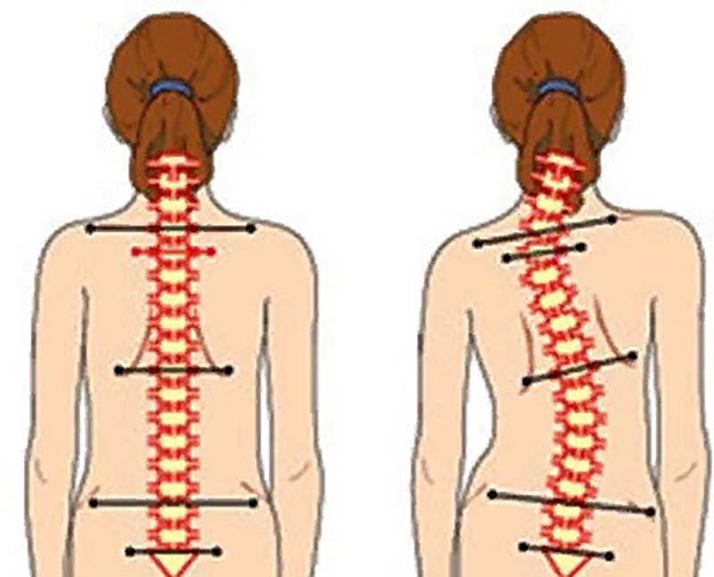 сколеоз.jpg
