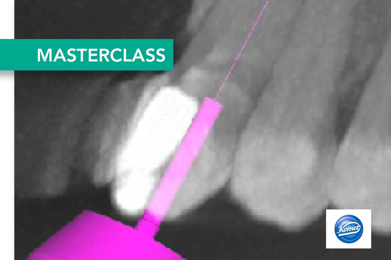 22 mei 2024: Endodontic Access Cavity Design Course - Christophe Verbanck (NL)