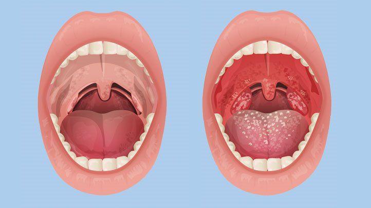 Do I Have Tonsillitis? All About Signs and Symptoms | Everyday Health