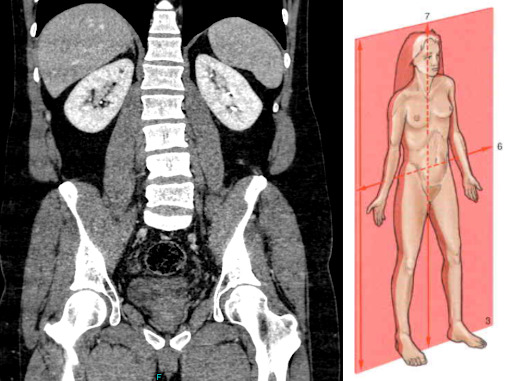 Plano coronal ao nível dos rins com o fígado (à esquerda) e o baço (à direita) imediatamente acima e a coluna lombar no meio. Fonte: Arquivo pessoal / Sobotta: Atlas de Anatomia Humana, página 1.