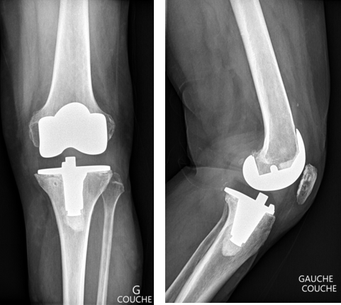 Chirurgie orthopédique pour traumatisme du genou à Aix-en-Provence ...