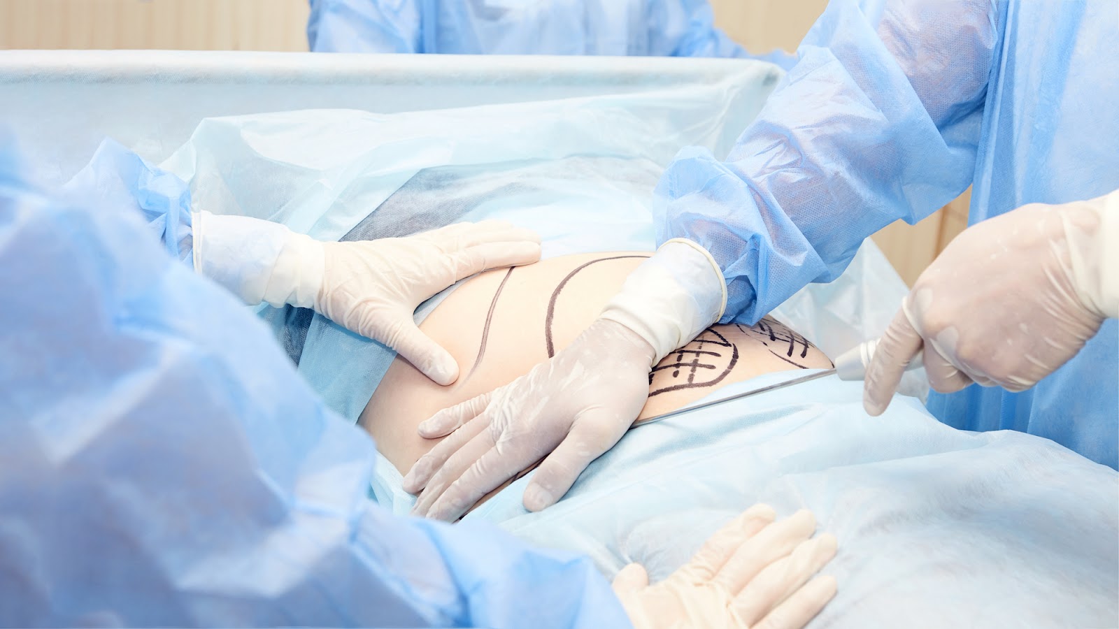 tummy-tuck-surgery