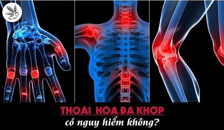 Tiên Thảo Cao có khả năng chữa thoái hóa đa khớp không?  G5olbC9ER_Vwot7VHQ9V9VFwlJAoFddHQH3E89GG6wwbFLtQA6amTZ94paKvO2GrROlh2nREcDsWgor4PCJVxo6z-oN8=w752