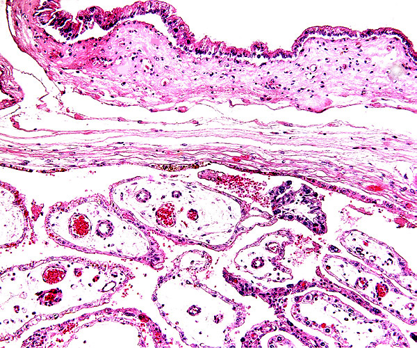 Surface of the placenta with few pigmented trophoblastic cells beneath chorionic plate. Above is the reflected membrane with tall trophoblast lining