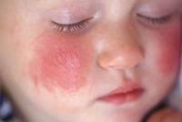 Red rashes on a baby's cheeks.