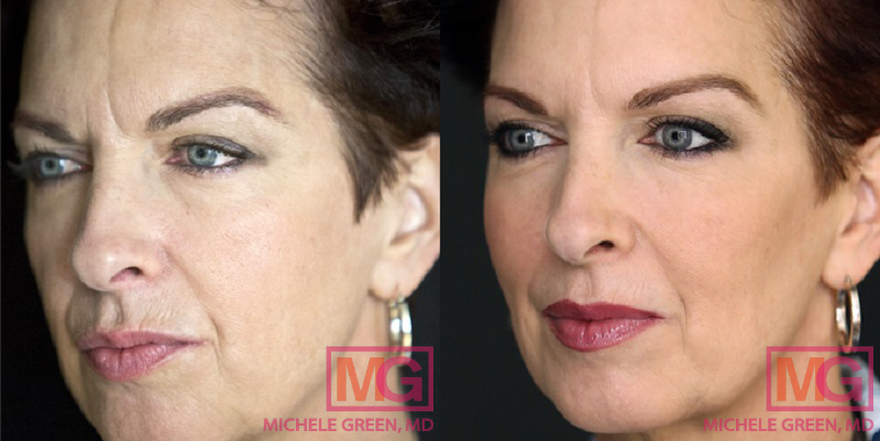 Picture of a botox before and after