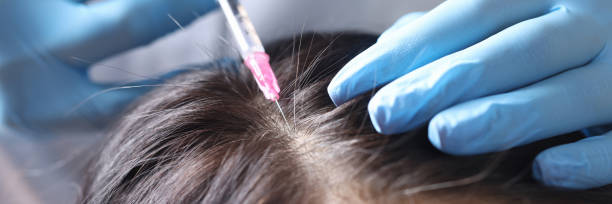 Hair Transplant Treatment in Delhi