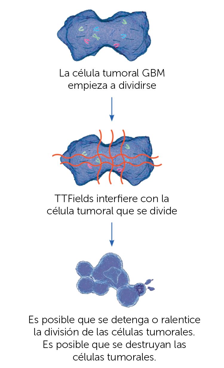 Cómo Optune® trata tumores cerebrales con TTFields