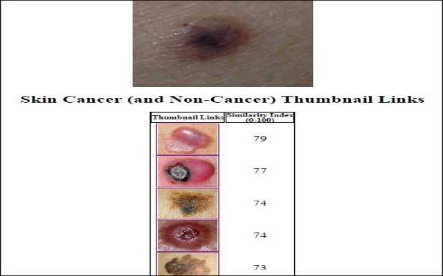 Skin Cancer Image Search chrome extension