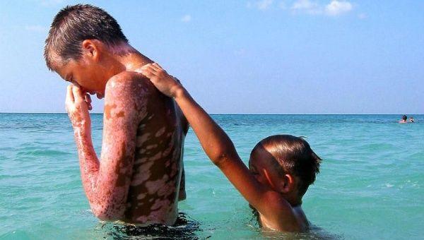 Vitali and Alexander, two Ukrainian victims of the nuclear plant meltdown in Chernobyl, play in Tarara beach, Cuba, nearby a pediatric hospital.