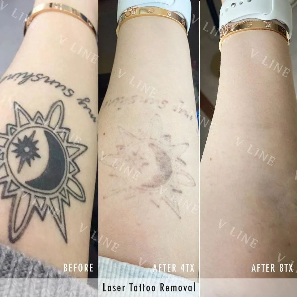 Before and after photos of laser tattoo removal for a big tattoo, you can see the tattoo is totally removed without burns or scars after 8 sessions of Picosure Laser Tattoo Removal