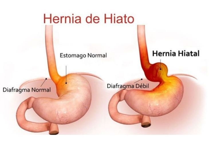 Tipos De Hernias Más Comunes Hernia de hiato