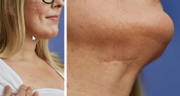 A picture of the scar on a woman's neck from Inspire