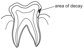 Dental decay and prevention