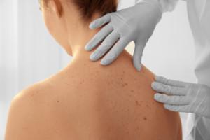 how to diagnose skin cancer? ichhori.webp