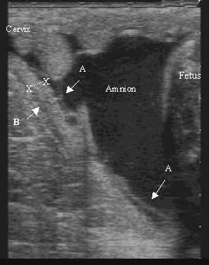 Ultrasonografía transrectal en una yegua al final de la gestación. A = membrana amniótica; B = rama media de la arteria uterina; x---x = espesor conjunto útero-placentario (ECUP).