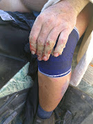 The biker sustained painful burn wounds 