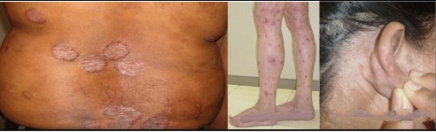 psoriasis on legs