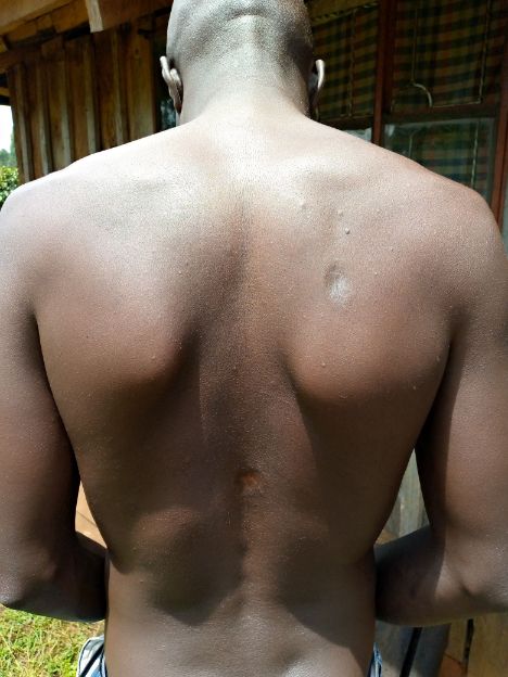 Collins Kiprono shows his back where the bullets hit before embedded inside his chest cavity.