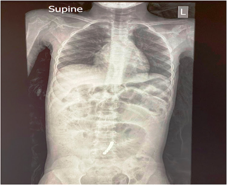 An x-ray showing the magnets in the Limpopo girl's intestine.