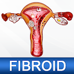 Cover Image of Herunterladen Uterine Fibroid Causes Symptoms Types & Treatment 1.4 APK