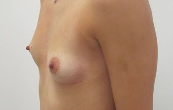Pre - Breast Enlargement surgery 