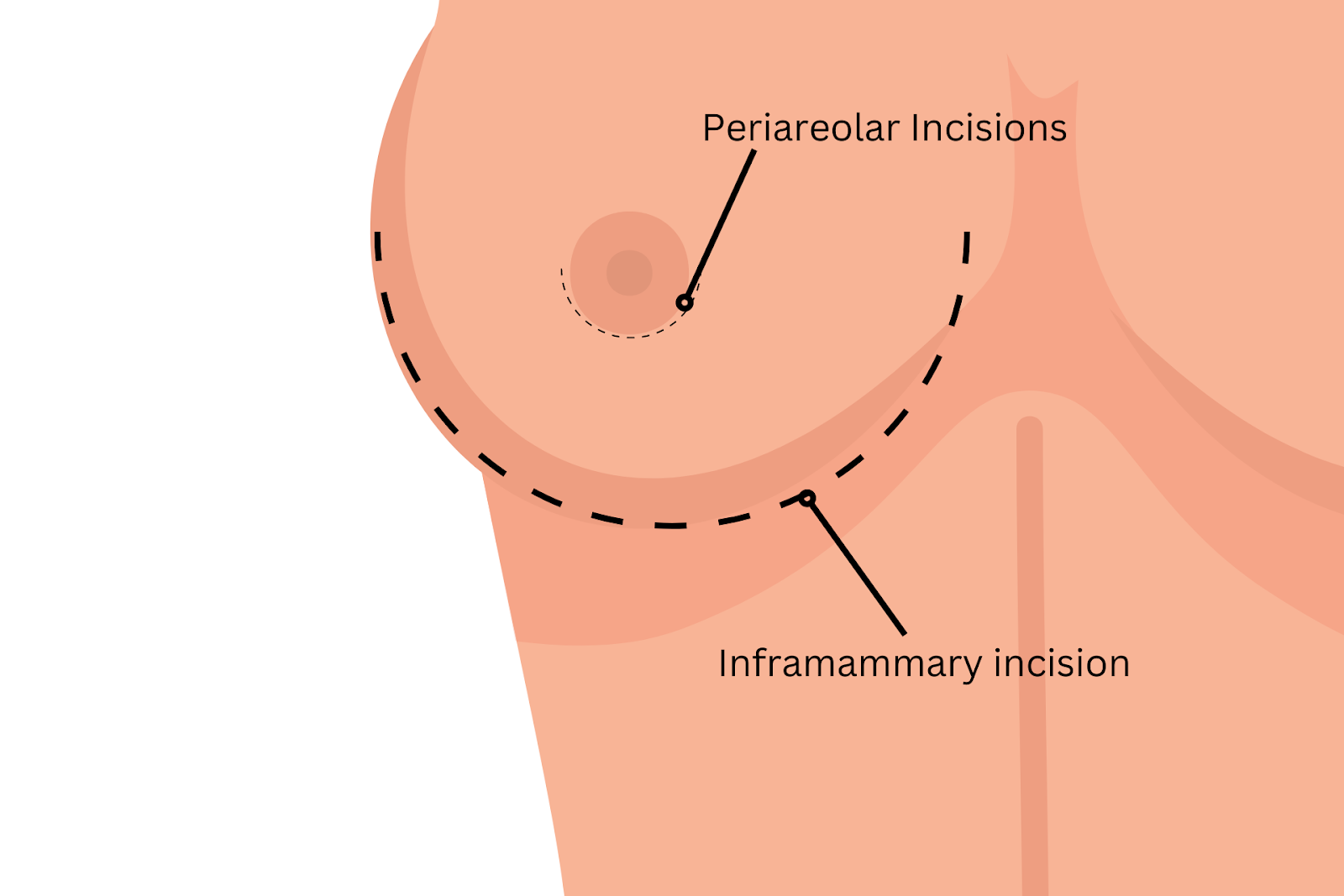 Locations of periareolar and inframammary incisions