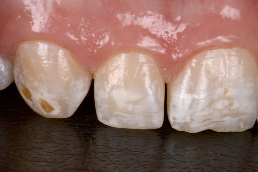 Fluorose dental: microabrasão do esmalte associado ao clareamento