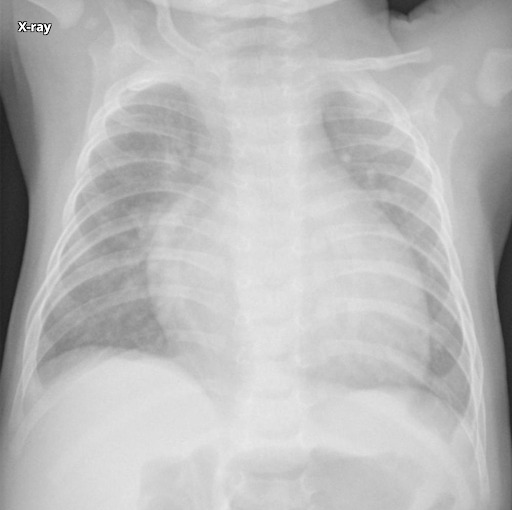 Defeito do septo atrioventricular - saiba mais