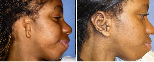 Before and after sugery of a microtia patient