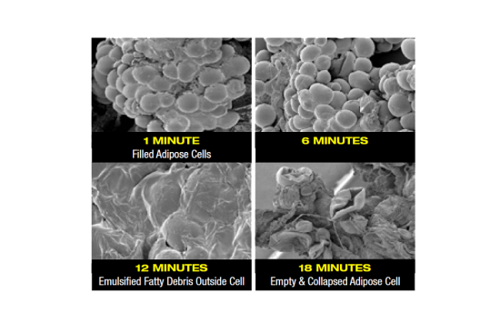 Fat Cells during treatment