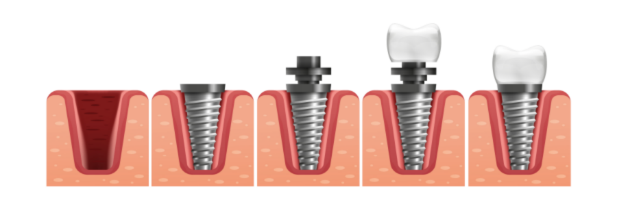 Etape inserare implant dentar