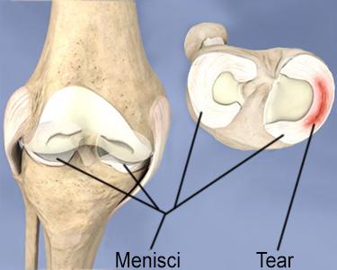 Torn Meniscus: Symptoms, Healing, Treatment, & Surgery | HSS