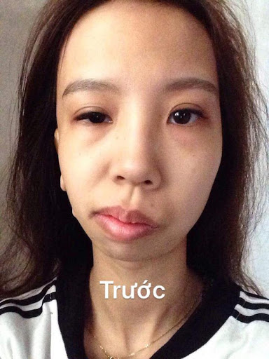 Gương mặt bị lệch sang một bên của Xuân Thương
