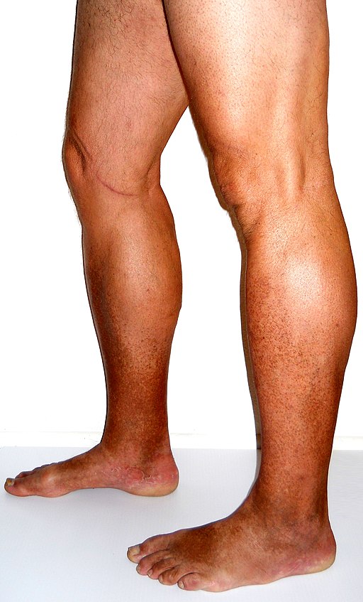 Why One Foot, Ankle, or Leg Might Be Swollen