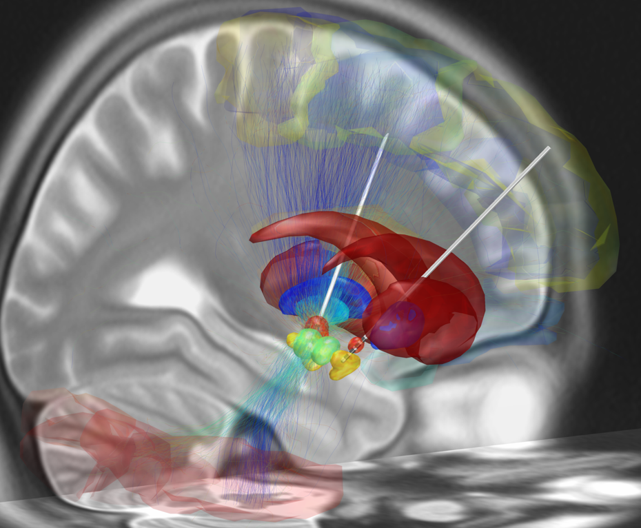 Deep_brain_stimulation_electrode_placement_reconstruction.png