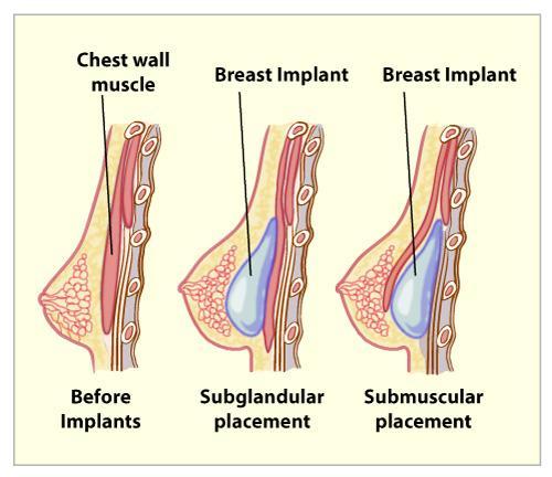 C:\Users\PC\Desktop\Amalia\CIRUGIA PLASTICA\implante sub glandular submuscular.jpg