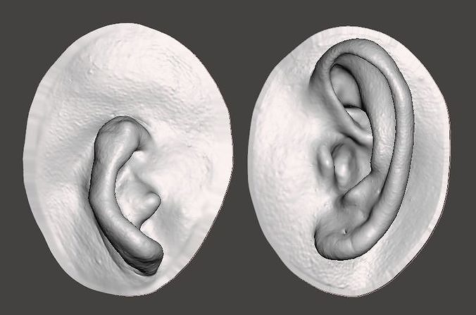 Before surgery( left) and after reconstructing the 3D Ear (right)