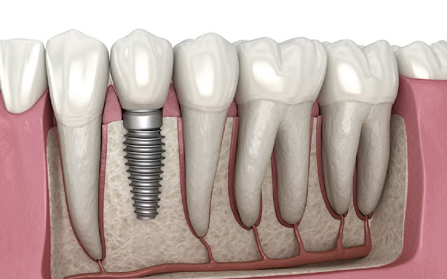 Top Dental Implant Services chrome extension